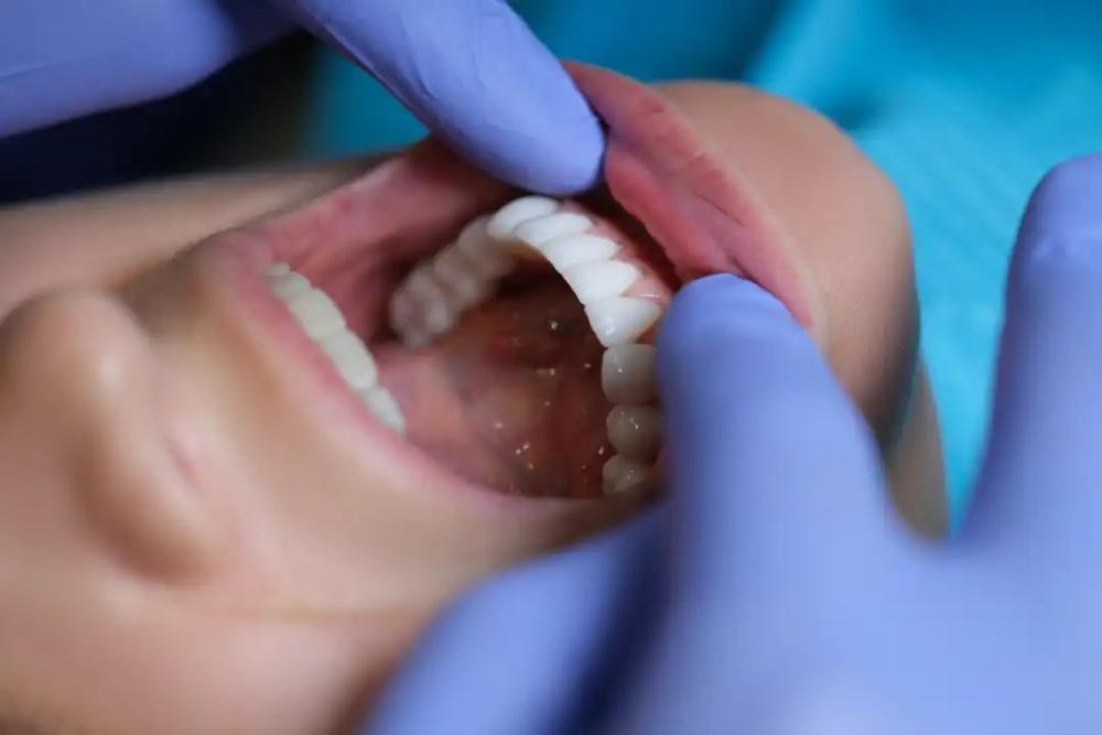 Composite Veneers Adelaide