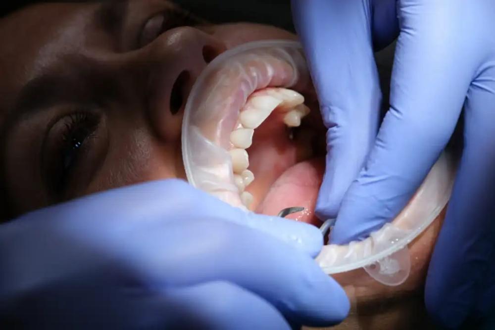 Composite Veneers Adelaide 