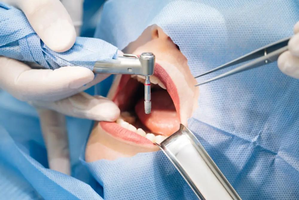 Dental Implants Adelaide Dental Implants Adelaide