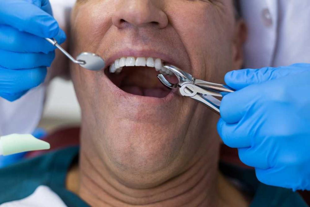 Tooth Extraction Adelaide 