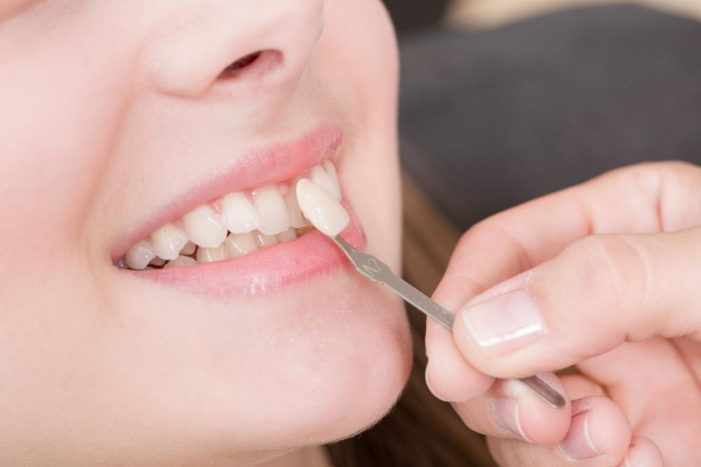 Veneers Adelaide veneers-adelaide